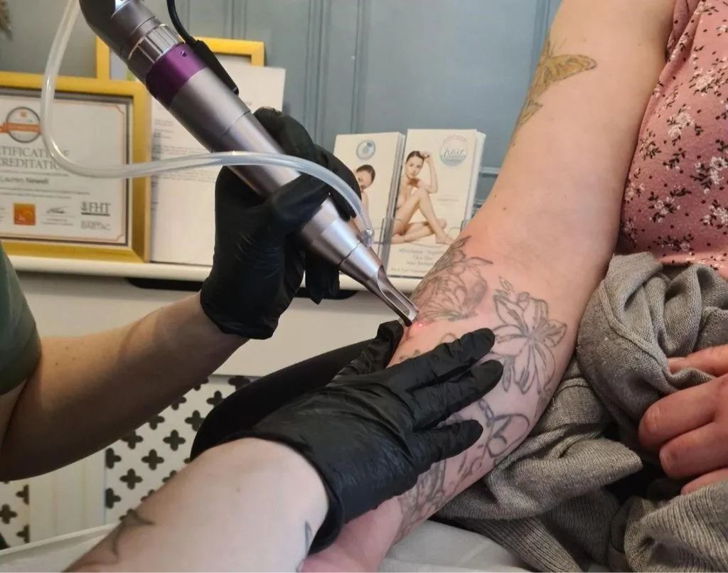 Laser Tattoo Removal