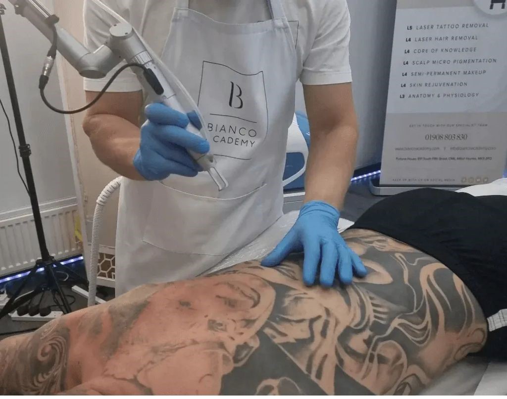 Laser Tattoo Removal